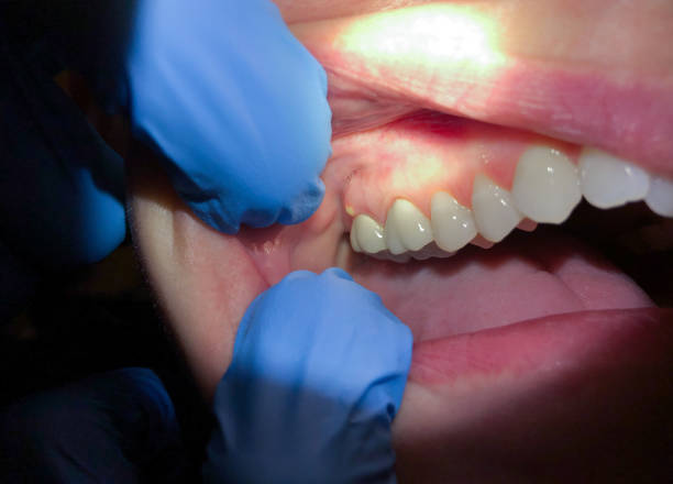 Best Dentist for Tooth Abscess  in Boyd, TX